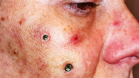 Sandra Lee, MDeliminates a huge blackheads from a woman's face. . Big blackheads popping